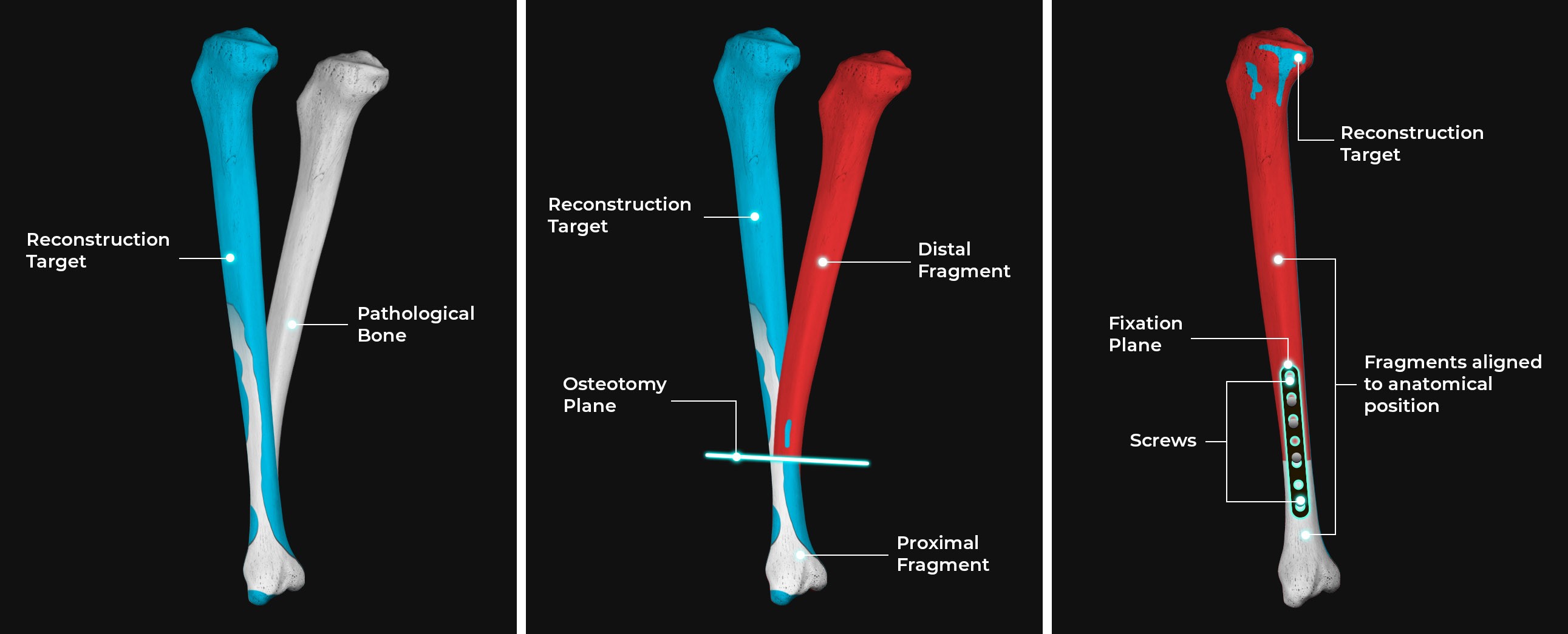 3D bone reconstruction